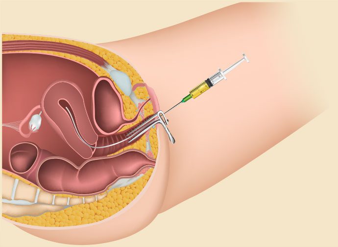 iui diagram 1